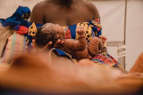 A mother holds her 1-month-old baby daughter at the mpox isolation unit of the UNICEF-supported Kamanyola Hospital in <a href=