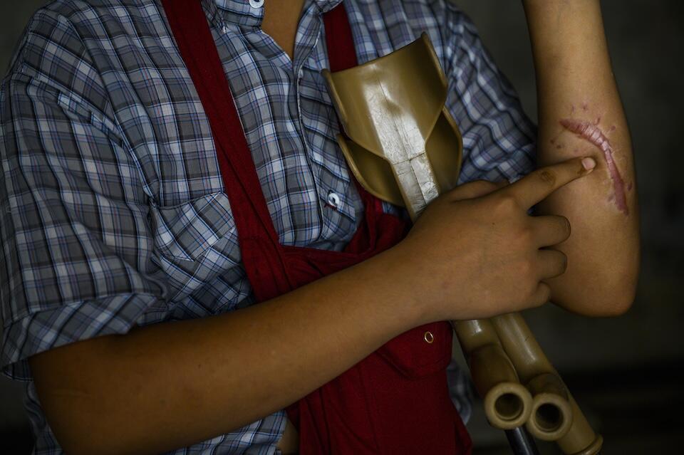 Aung, 15, points to a scar caused by a landmine. He was tending to his family’s rice farm when he accidentally stepped on the landmine, in early December 2023.