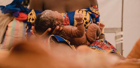 A mother holds her 1-month-old baby daughter at the mpox isolation unit of the UNICEF-supported Kamanyola Hospital in South Kivu province, Democratic Republic of the Congo, on July 24, 2024.